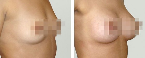 Маммопластика: до и после – фото 22
