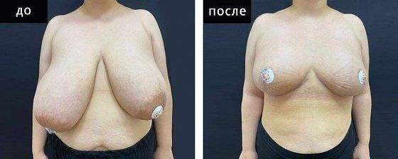 Маммопластика: до и после – фото 40