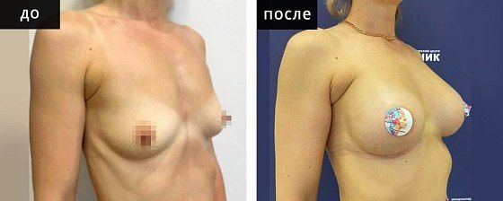 Увеличение груди. Мурзаева 08: до и после – фото 12