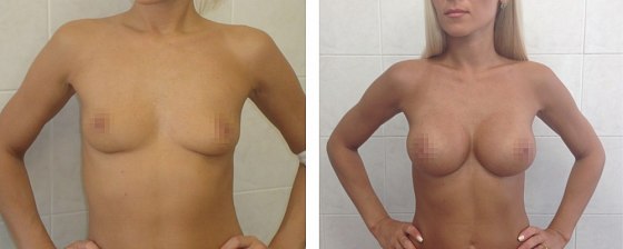 Маммопластика: до и после – фото 31