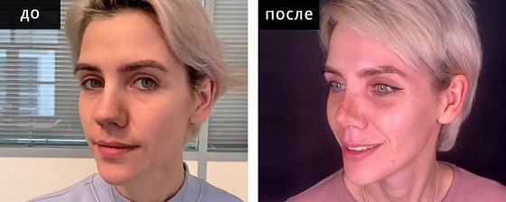 Ринопластика: до и после – фото 9