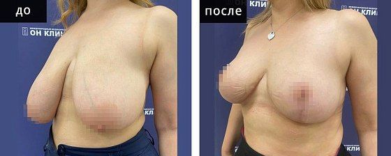 Подтяжка груди. Мурзаева 25: до и после – фото 15