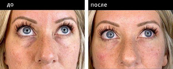 Контурная пластика области глаз. Мельниченко 13: до и после – фото 3