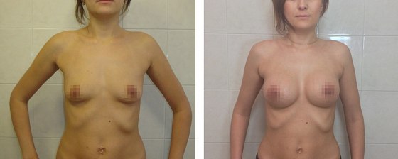 Маммопластика: до и после – фото 24