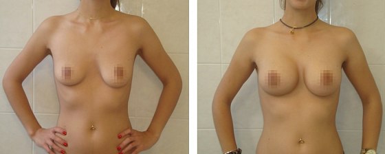 Маммопластика. Еременко В.С._19: до и после – фото 16