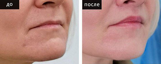 Пластика губ. Глебова 02: до и после – фото 8