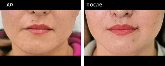 Пластика губ. Глебова 07: до и после – фото 4