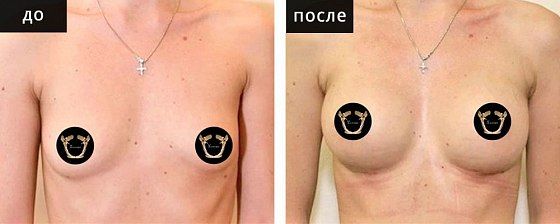 Маммопластика аугментационная. Гусляков 06: до и после – фото 14