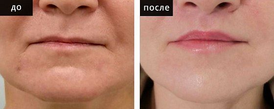 Пластика губ. Глебова 03: до и после – фото 5