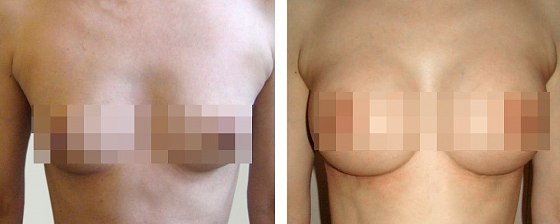 Маммопластика: до и после – фото 41