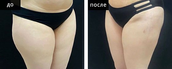 Мурзаева_Высокоточная липоскульптура: до и после – фото 5