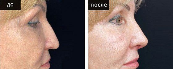 Ринопластика: до и после – фото 14