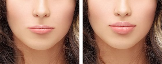 Контурная пластика губ: до и после – фото 2