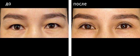 Блефаропластика азиатских глаз. Болотбекова 03: до и после – фото 2