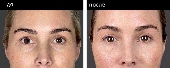 Контурная пластика вокруг глаз: до и после – фото 1