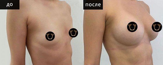 Маммопластика: до и после – фото 19