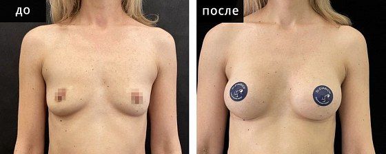 Маммопластика аугментационная. Зварич 01: до и после – фото 24