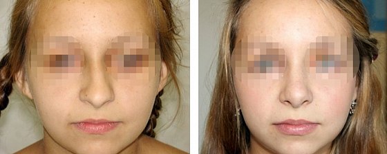 Ринопластика: до и после – фото 2