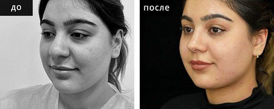 Ринопластика: до и после – фото 31
