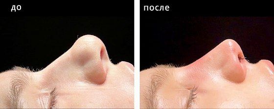 Ринопластика: до и после – фото 36
