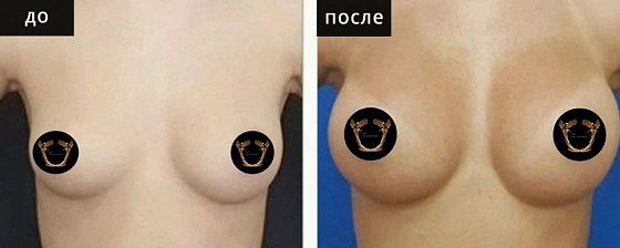 Маммопластика аугментационная. Гусляков 08: до и после – фото 16