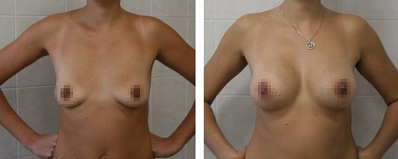 Маммопластика: до и после – фото 33