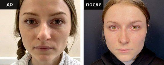 Ринопластика: до и после – фото 21