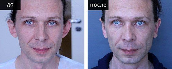 Устранение лопоухости: до и после – фото 2