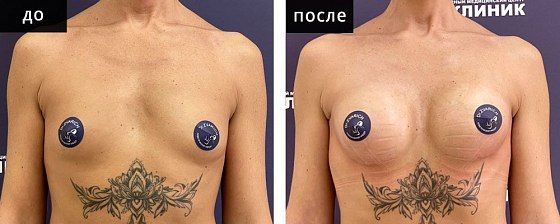 Маммопластика аугментационная. Зварич 06: до и после – фото 29