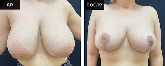 Подтяжка груди. Мурзаева 10: до и после – фото 13