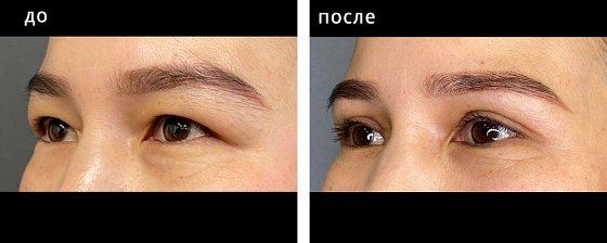 Блефаропластика азиатских глаз. Болотбекова 02: до и после – фото 1