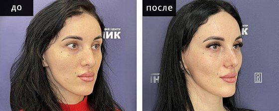 Ринопластика: до и после – фото 42