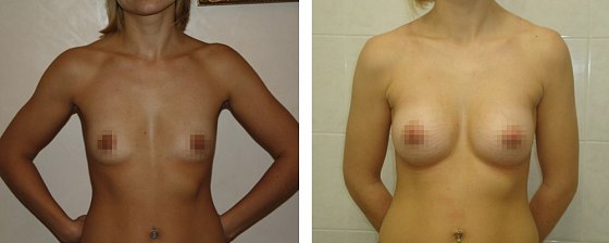 Маммопластика. Еременко В.С._15: до и после – фото 41