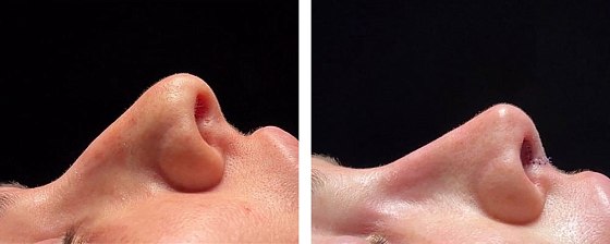Ринопластика: до и после – фото 29