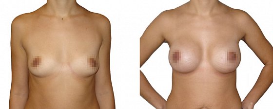 Маммопластика: до и после – фото 36