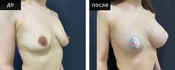 Маммопластика: до и после – фото 47