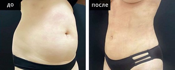 Мурзаева_Высокоточная липоскульптура: до и после – фото 6