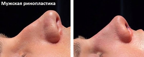 Ринопластика: до и после – фото 54