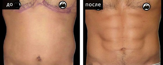 Липоскульптура. Липосакция. Гусляков 02: до и после – фото 2