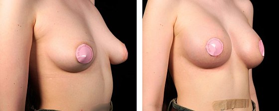 Маммопластика: до и после – фото 29