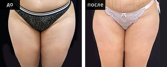 Мурзаева_Высокоточная липоскульптура: до и после – фото 9