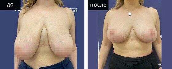 Подтяжка груди. Мурзаева 26: до и после – фото 16