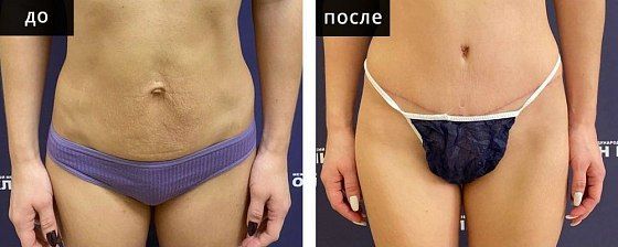 Абдоминопластика (удаление диастаза прямых мышц живота). Мурзаева 04: до и после – фото 1