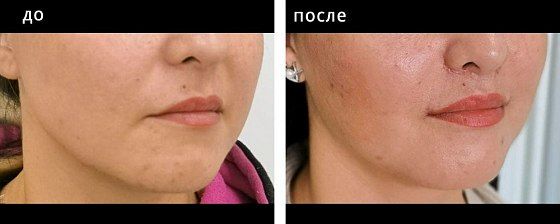 Пластика губ. Глебова 05: до и после – фото 2