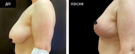 Мастопексия. Гусляков 01: до и после – фото 1