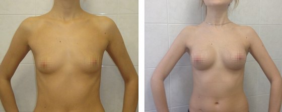 Маммопластика. Еременко В.С._23: до и после – фото 21