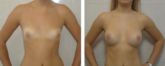 Маммопластика. Еременко В.С._32: до и после – фото 29