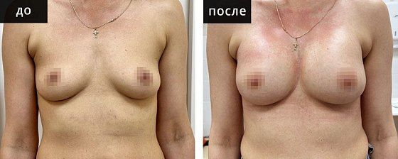 Маммопластика: до и после – фото 6