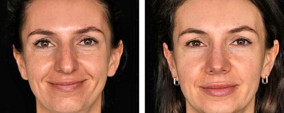 Ринопластика: до и после – фото 30