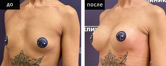 Маммопластика аугментационная. Зварич 08: до и после – фото 31